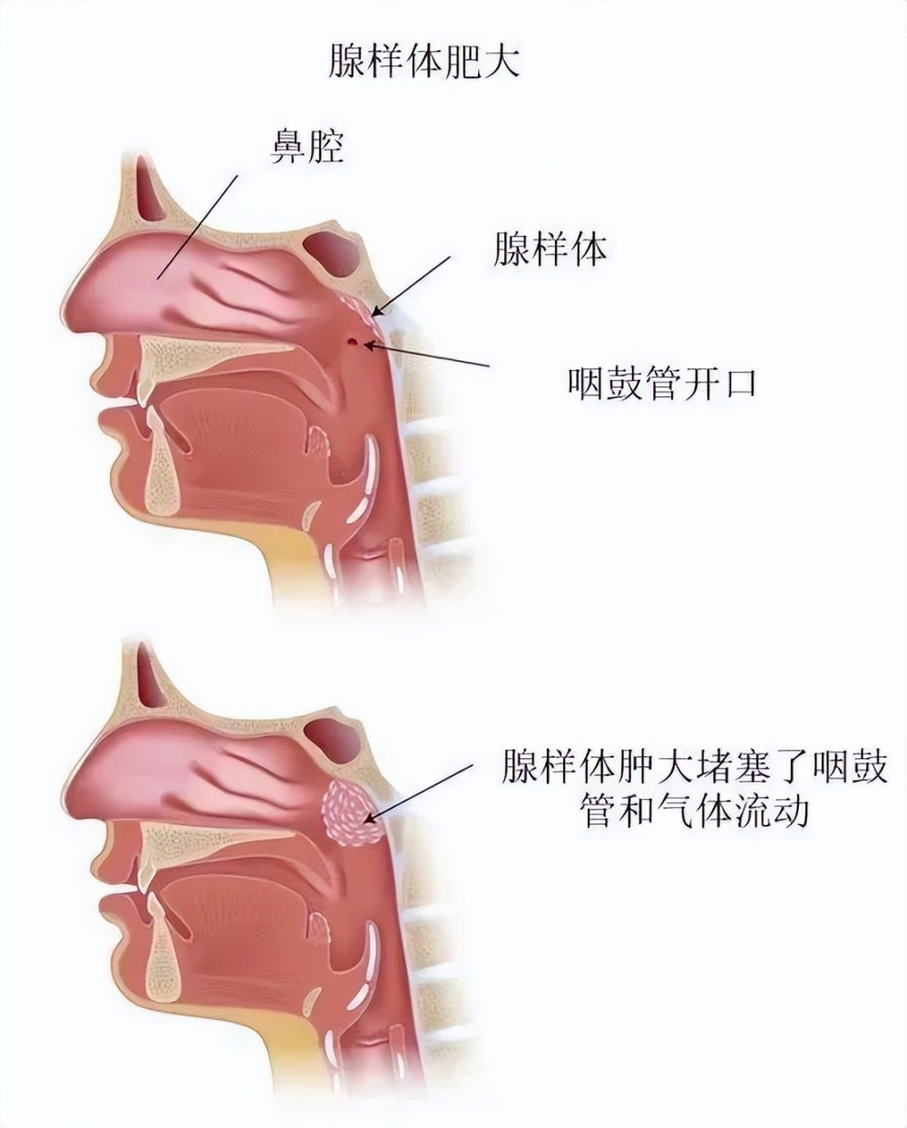 腺样体肥大是什么病症?