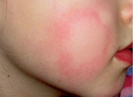 5 类常见儿童荨麻疹,你是否都已掌握?