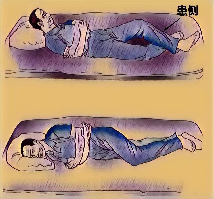 脑卒中患者的康复治疗——翻身训练