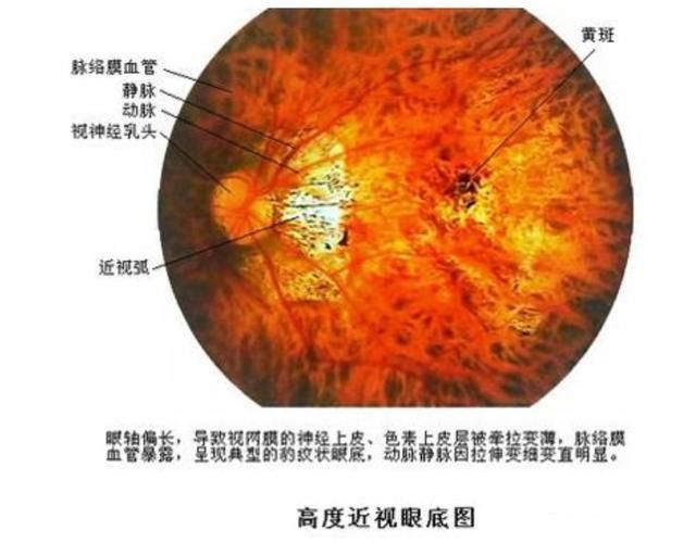 如视网膜劈裂,黄斑裂孔,黄斑出血,脉络膜新生血管,视网膜脱离,脉络膜