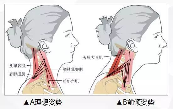 本课时,我们主要通过放松上斜方肌,肩胛提肌,胸锁乳突肌,舒缓上背部的