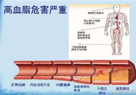 我国血脂异常人数已超4亿,科学调脂不容忽视