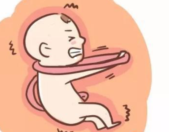 后怕孕妈最容易忽略的1个动作竟导致胎儿脐带绕颈