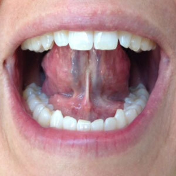健康人的舌头应该是粉红色的,但是对于血管堵塞的人来说,舌头常常是