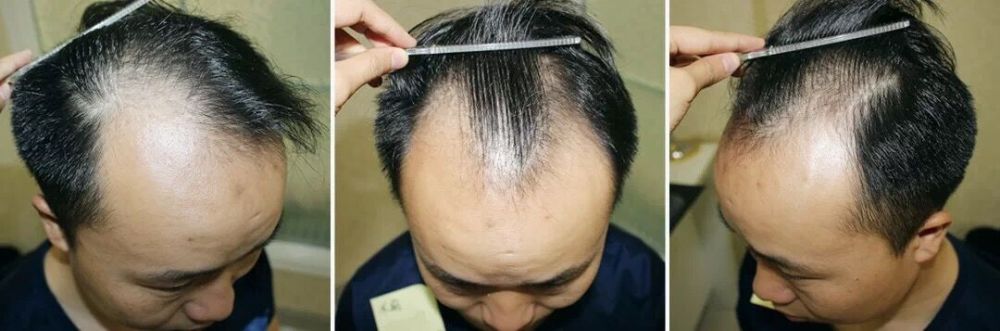 如果毛囊坏死,想到北京科发源做毛发种植,得需要多少钱?