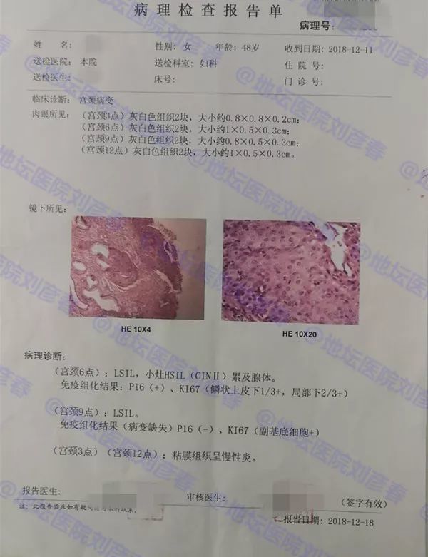 病例分享---手上有扁平疣,是提示有宫颈癌吗?这个病例