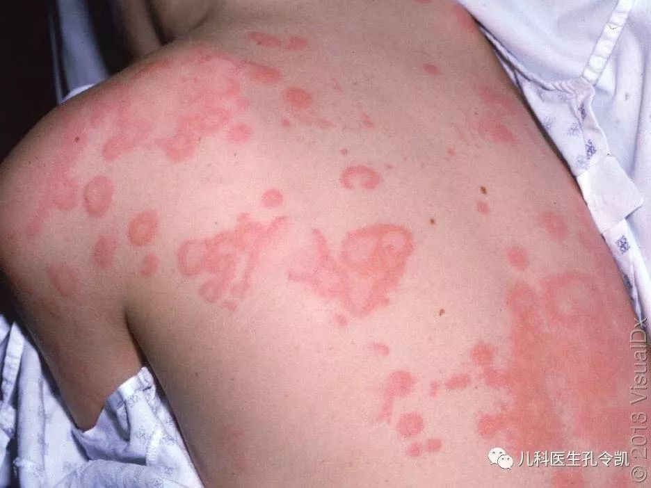 荨麻疹是孩子们非常常见的的皮疹,大约1/5～1/4的人,一生中总会起