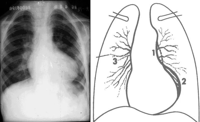心脏增大分型 二尖瓣形(或称梨形) 心腰部凹陷,肺血减少,肺门血管
