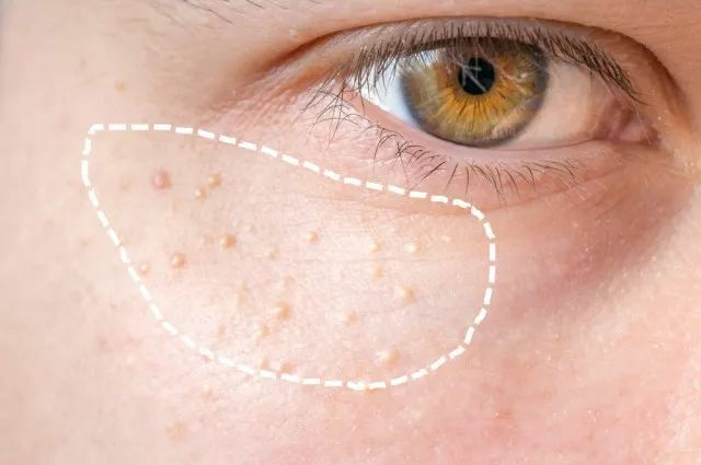 脂肪粒 | 眼周皮肤上疙疙瘩瘩,是哪些原因造成,又该如何祛除?