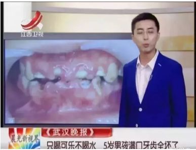 每天只喝可乐不喝水,睡前喝牛奶从不刷牙,这样一位 5岁男孩14颗牙齿齐