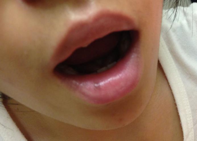 研究发现,嘴唇出现黑斑的话,可能就是黑斑息肉病的表现.
