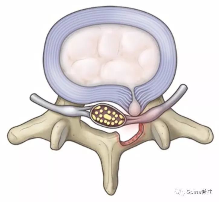 横断位所示椎板切除后暴露的突出椎间盘