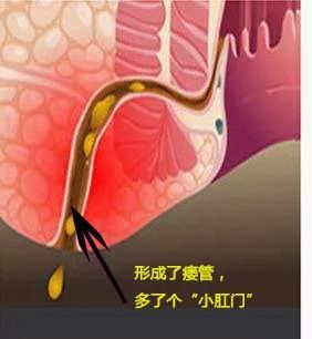 大部分肛瘘由直肠肛管周围脓肿引起,脓肿自行破溃或切开引流处形成外
