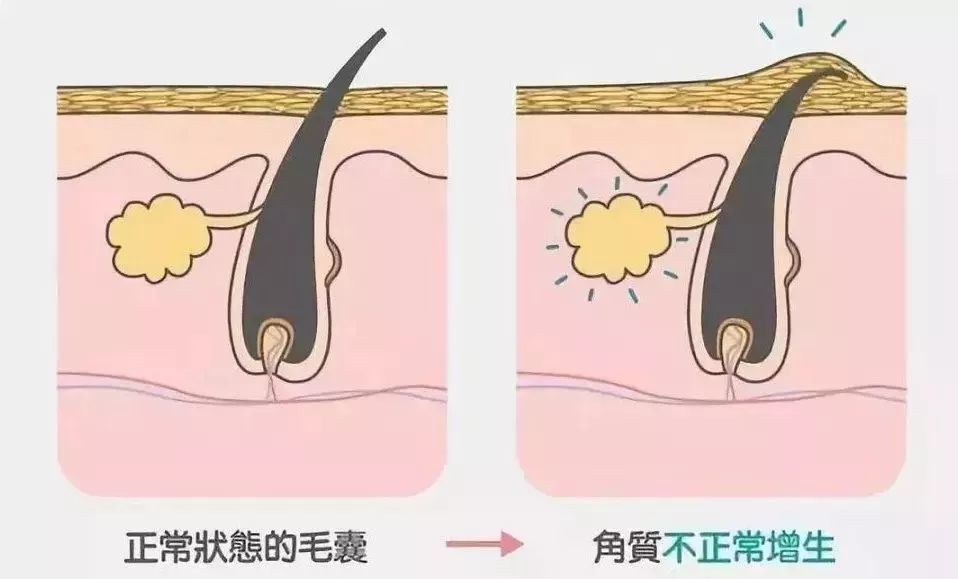 鸡皮肤即毛周角化病,又叫毛发角化病,是一种慢性毛囊角化性疾病.