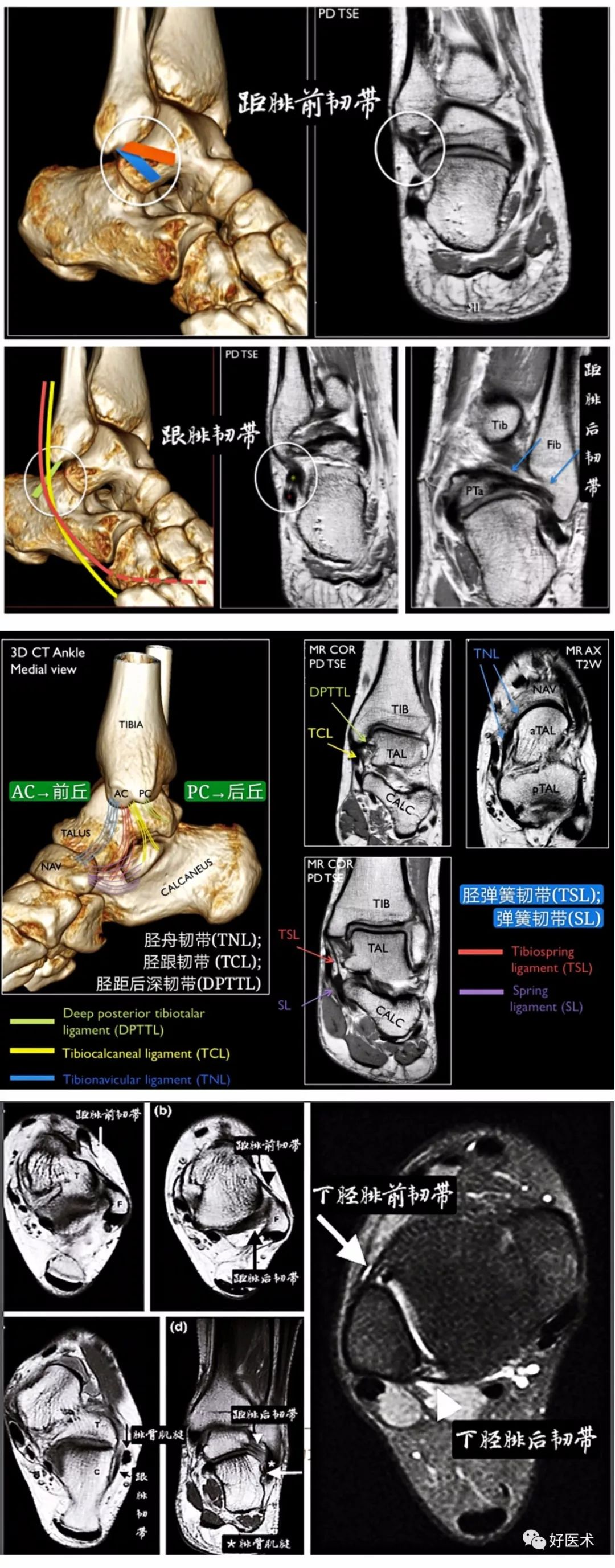 一文搞定!踝关节周围韧带的解剖及mri特征