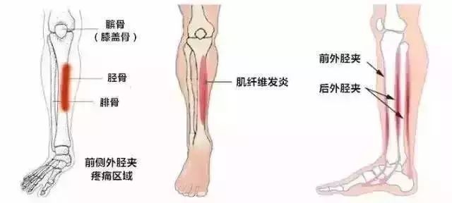 跑完步小腿骨头疼小心了不重视可能会骨折