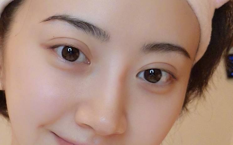 1.什么是割双眼皮
