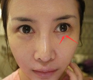女人眼睛下面出现皱纹代表什么?