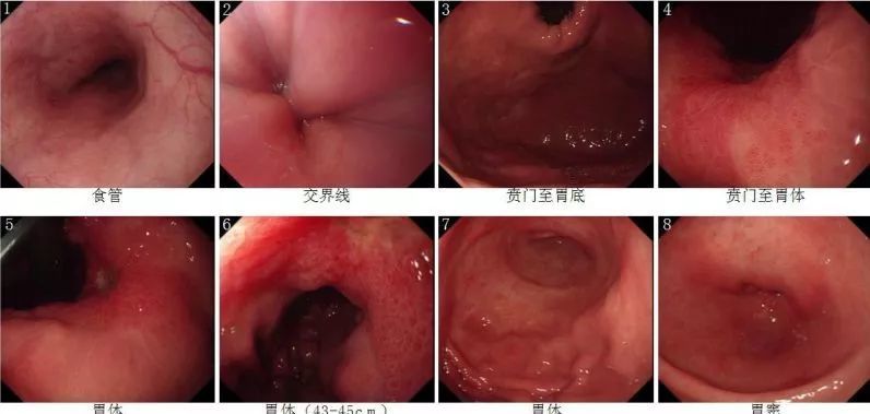 内镜下早癌,息肉等病变诊断体会