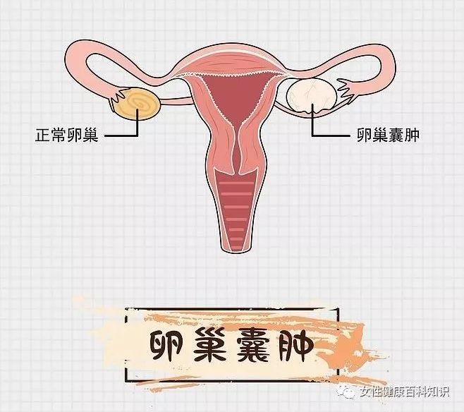 卵巢囊肿的症状可能多种多样,但最常见的是卵泡在排卵期闭锁而不是