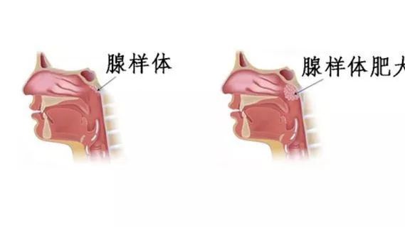 腺样体肥大是与腺样体大小增加有关的阻塞性疾病,在有或没有腺样体的