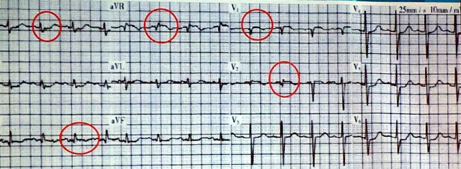心电图:siqiiitiii,avr,v2,v2导联st段抬高 案例2 总结: 心电图对于