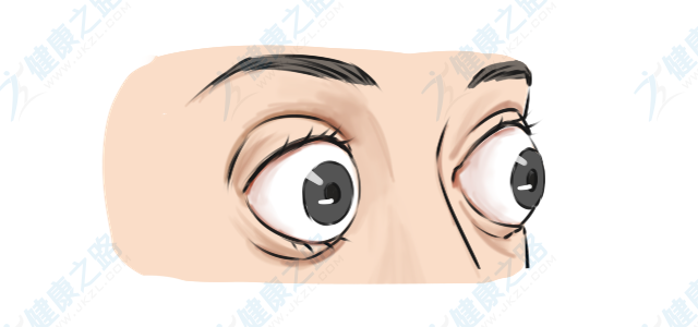 随着近视度数的加深,眼轴长度的增加,就有可能出现眼球突出的情况