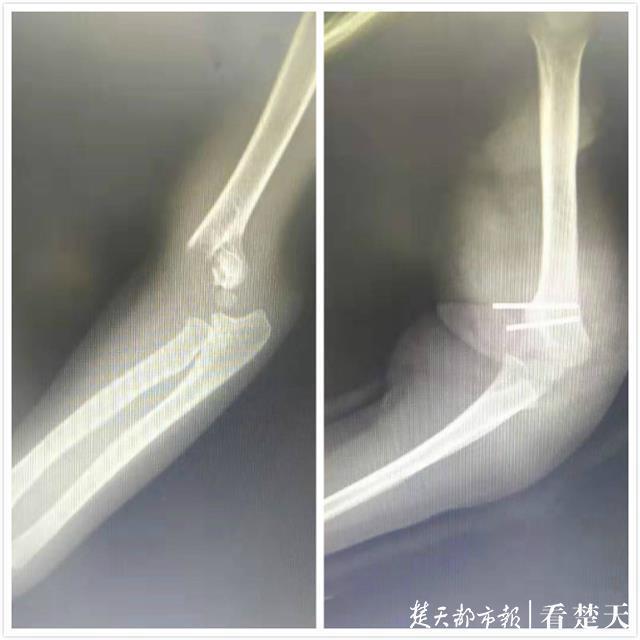 2岁半宝宝把沙发当蹦床玩,不慎一脚踩空胳膊摔骨折