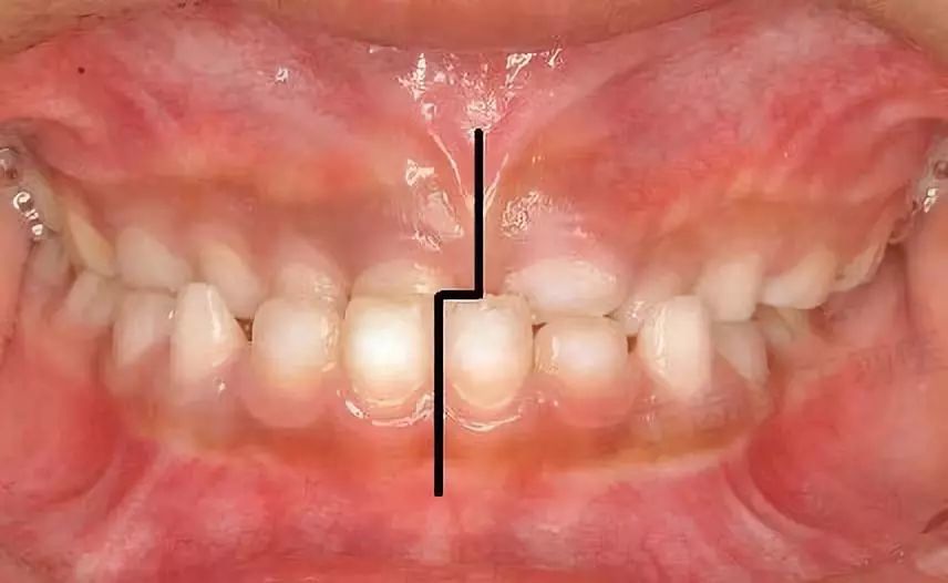牙齿拥挤地包天下颌偏斜乳牙期哪些问题需要早期矫治