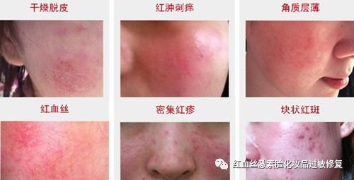 激素脸总是起小红疹子怎么治 激素脸疹子如何去除