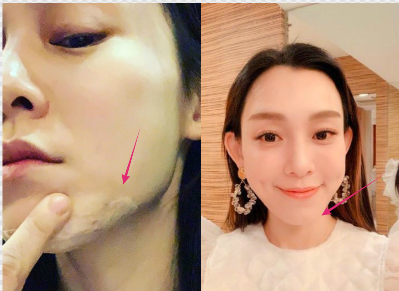 通过把范玮琪缝针后的下巴与未受伤的对比,真不知道她撞到家里的什么