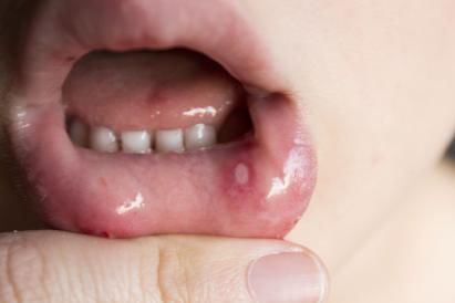 鹅口疮,口腔溃疡和疱疹性咽颊炎,这样区分最靠谱