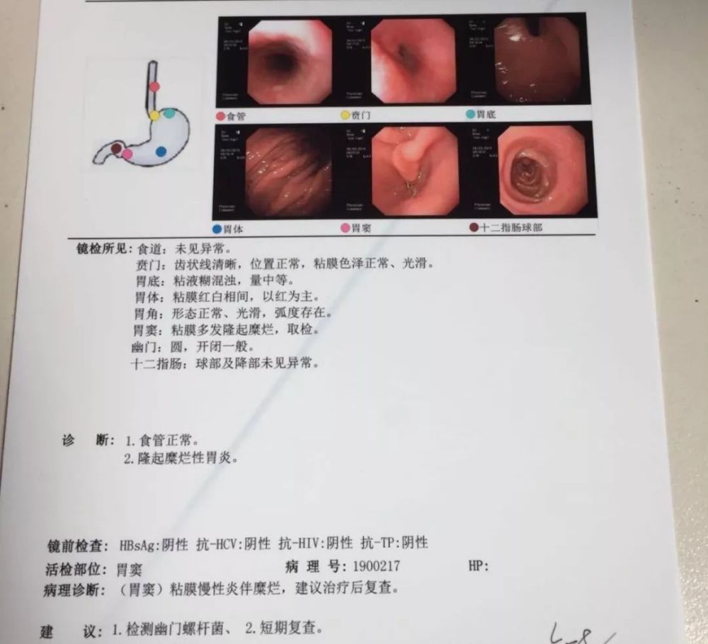 胃隆起型糜烂的原因和治疗