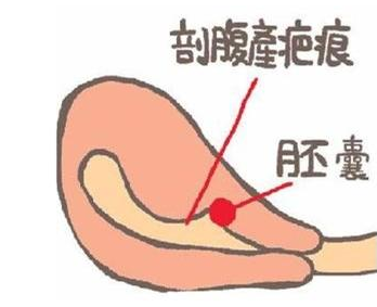 子宫瘢痕憩室是什么?影响生二胎吗?看妇产科医生怎么说