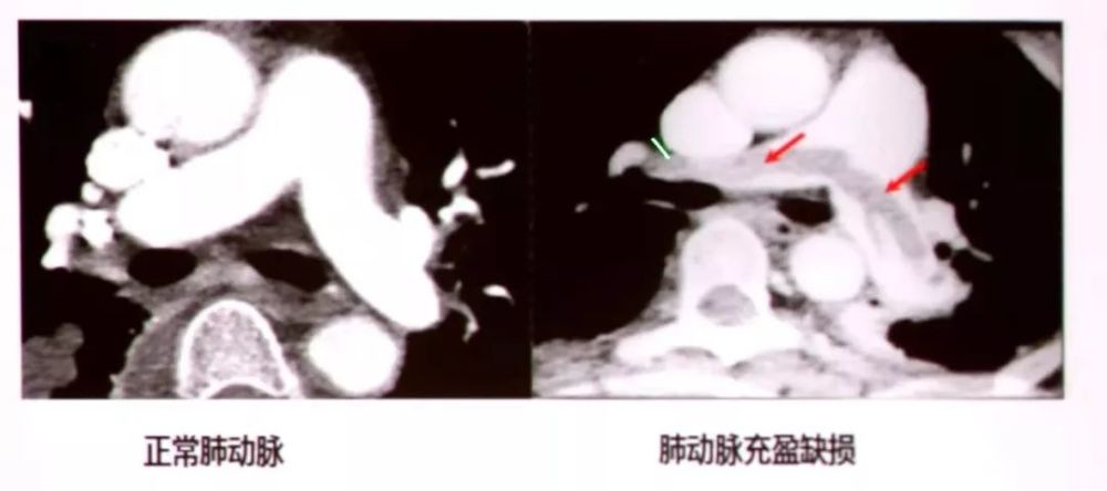 确诊肺栓塞的方法,这篇文章讲全了!