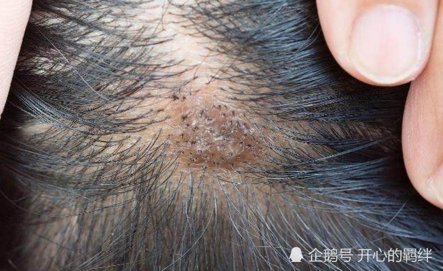 头皮上经常长疙瘩或者脓包,它是由于毛囊炎所导致的.