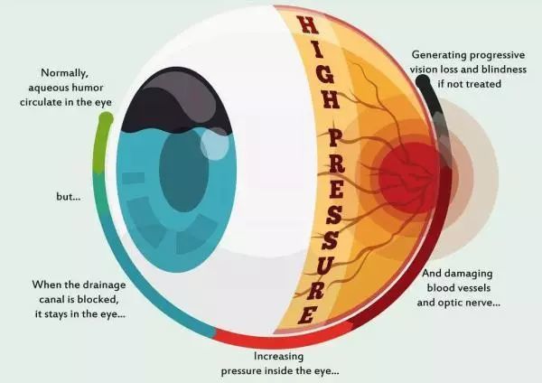 你不了解的"视力小偷—青光眼|虹视|青光眼|眼压|致盲|视神经损害