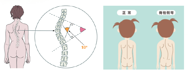 孩子坐姿老不对警惕脊柱侧弯