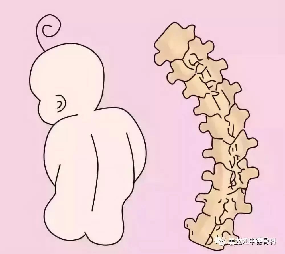 脊柱侧弯要从幼儿时抓起,您留意了吗?