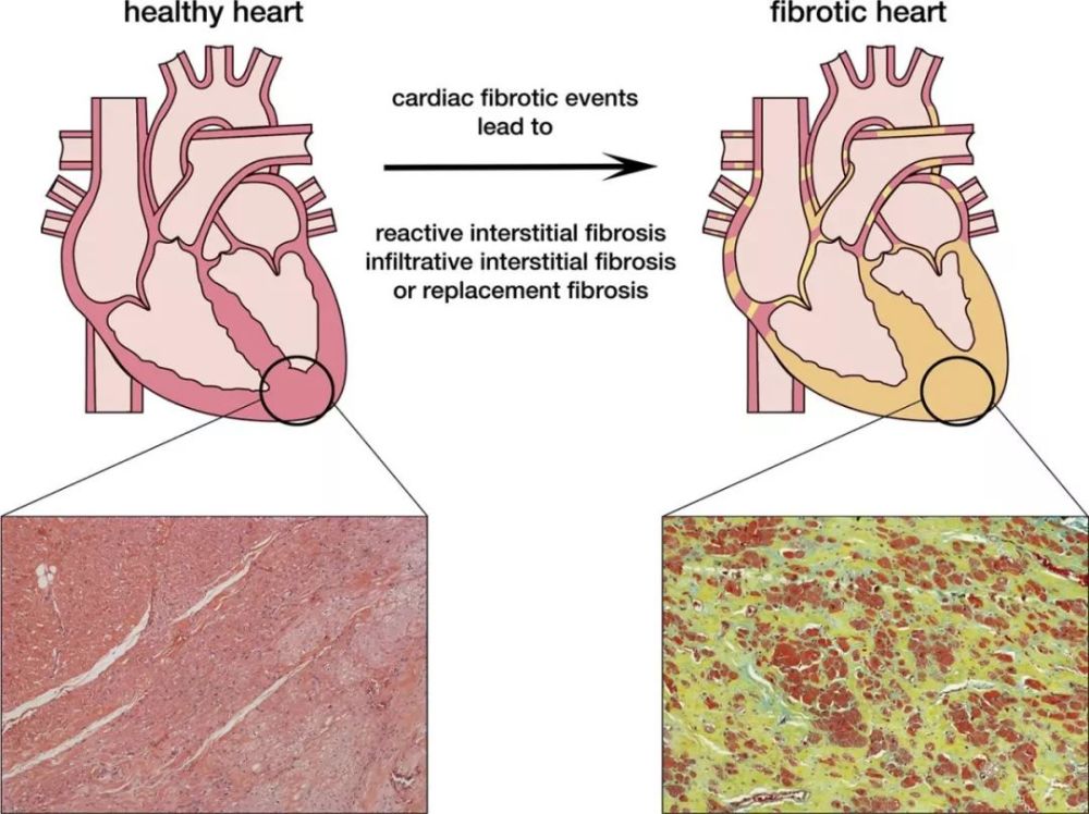心肌纤维化(图片来源: 参考资料[2])