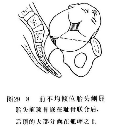 矢状缝后移接近骶岬. 5)颏后