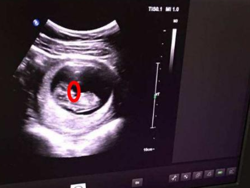 宝妈怀孕13周,做nt检查显示胎儿嘴巴处有阴影,是怎么