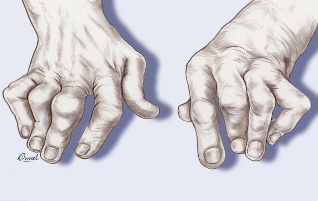 如何消除痛风石（如何消除痛风石怎样去除痛风石）