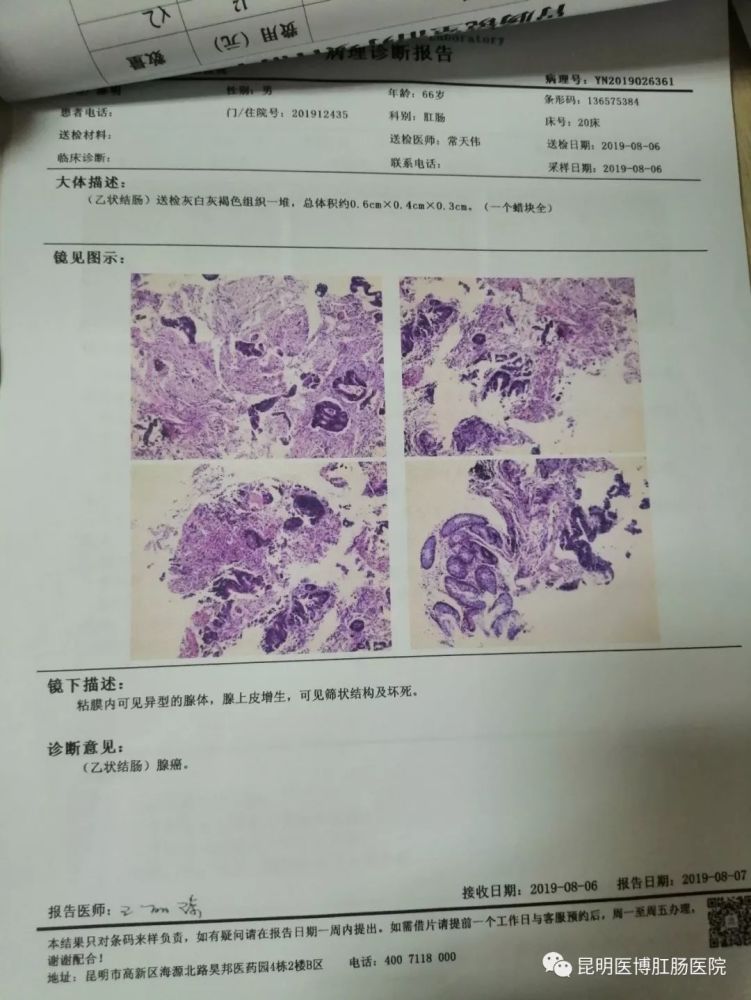 一名老警察的一念之差:肛门息肉未治疗 2个月恶化为结