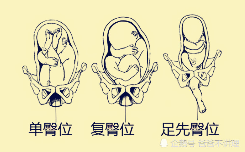 孕期一直左侧睡,但是宝宝仍然臀位,宝妈如何调整?