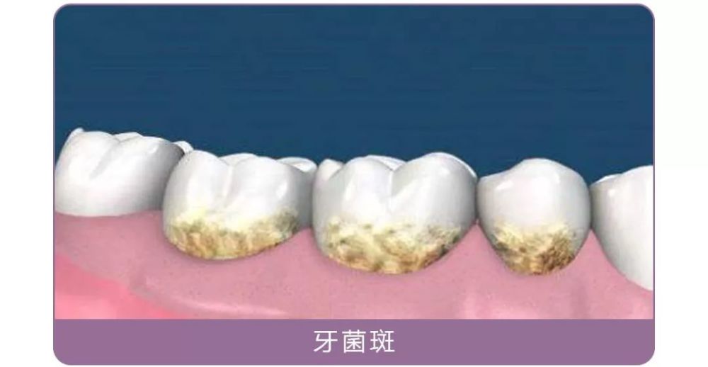 电动牙刷真的比手动牙刷刷得更干净?