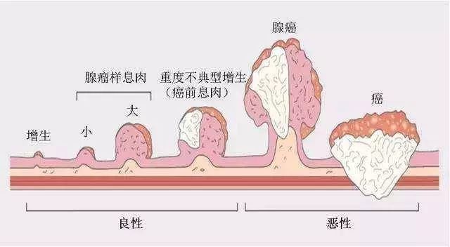 长了大肠息肉,离癌症还有多远?