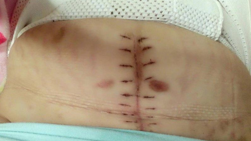 剖腹产手术后,孕妈肚子上留下的"疤痕"会有何影响?这些要清楚