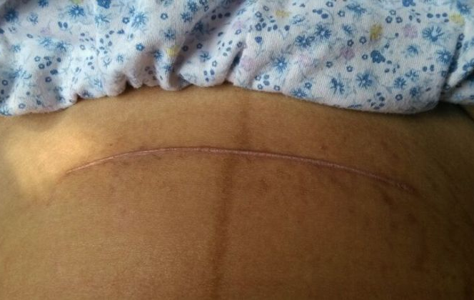 剖腹产手术后,孕妈肚子上留下的"疤痕"会有何影响?这些要清楚