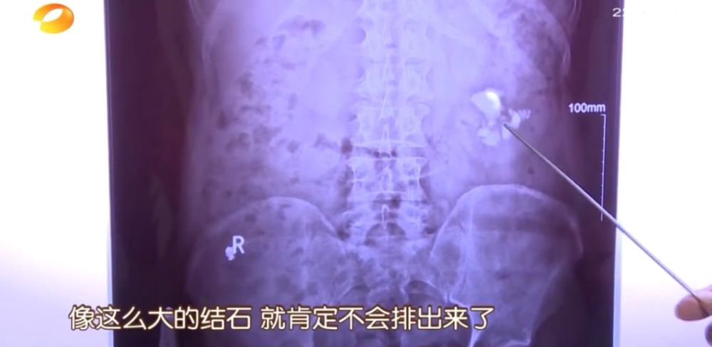 长沙一男子尝试气功治5公分大结石结果反致肾脏积水